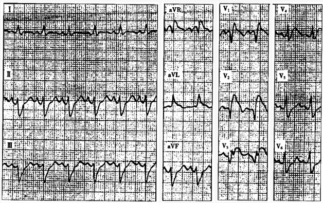 患者男性，70岁，糖尿病。因突发胸痛2小时就诊，心电图如下图所示。应诊断为（）。
