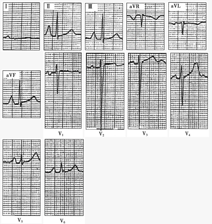 患者男性，47岁，风湿性心脏病，二尖瓣狭窄。心电图如下图所示，应诊断为（）。