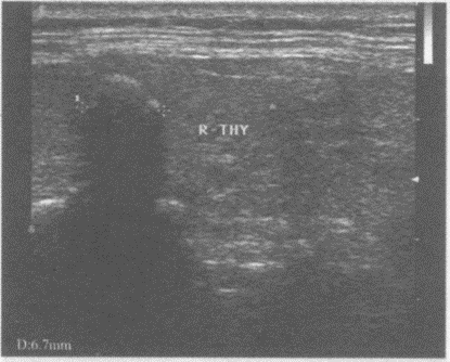 临床资料：女，37岁，常规体检。超声综合描述：甲状腺右叶可见直径0．7cm弧形强回声光带，后伴声影。