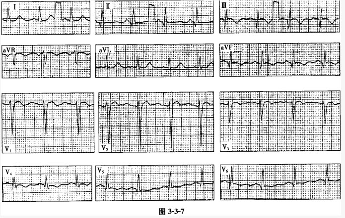 患者男性，56岁，1年前因急性心肌梗死入院，近3月胸闷，查心电图如图3-3-7所示，应诊断为（）。