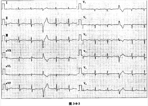 患者男性，16岁，病毒性心肌炎。心电图如图3-8-3所示，诊断为窦性心律，室性期前收缩。此室性期前收