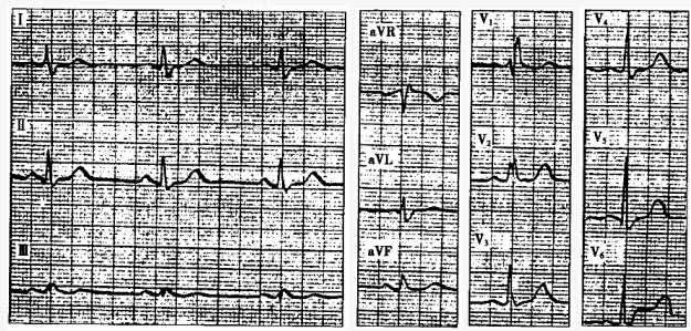 患者男性，42岁，体检。心电图如下图所示，应诊断为（）。
