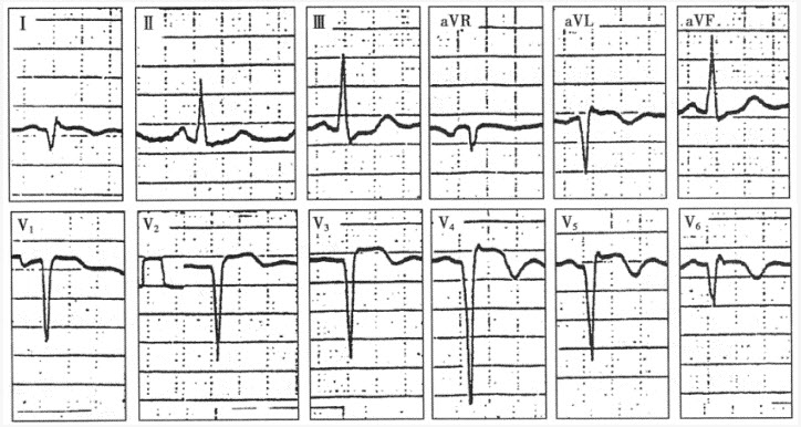 患者女性，63岁，因突发持续性胸痛就诊，心电图如下图所示，应诊断为（）。