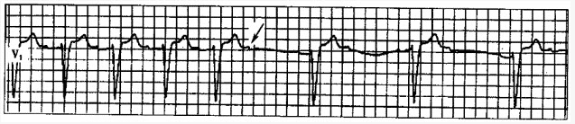 患者女性，56岁，头晕、心悸3天就诊。心电图如下图所示。该患者2：1阻滞的部位最可能在（）。