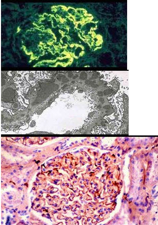 图-1IgG沿毛细血管壁细颗粒状沉积，图-2免疫荧光显微镜所见：IgG和补体呈细颗粒沉积于肾小球毛细