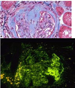 下述两张病理图片(图-1光镜为Masson染色，图-2免疫荧光镜下：IgM节段团块沉积)考虑是()