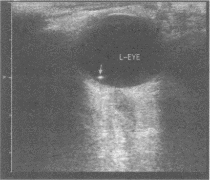 临床资料：女，33岁，爆炸伤后左眼不适。超声综合描述：双眼球形态正常，双眼球玻璃体内可见数个点状强回