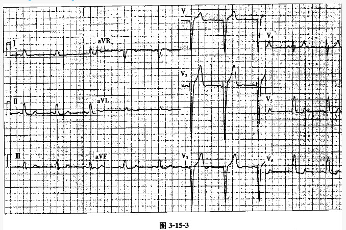 患者女性，65岁，冠心病。心电图如图3-15-3所示，应诊断为（）。