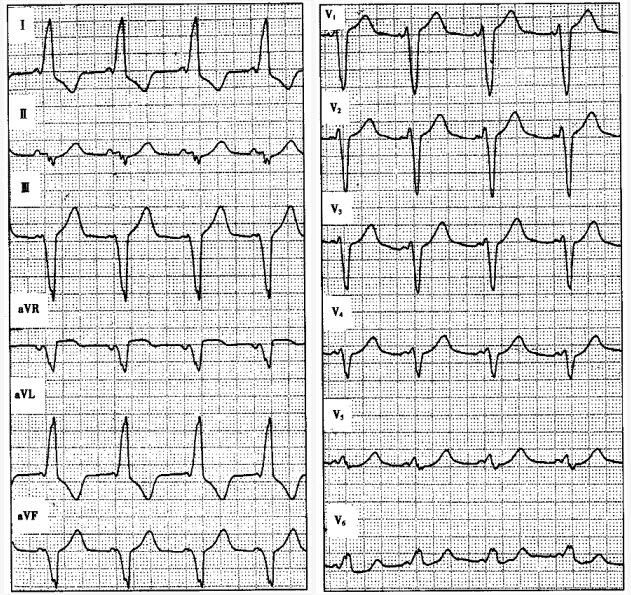 患者男性，30岁，阵发性心悸1年。心电图如下图所示，应诊断为（）。