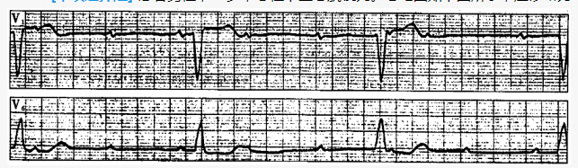 患者男性，72岁，急性下壁心肌梗死。心电图如下图所示，应诊断为（）。