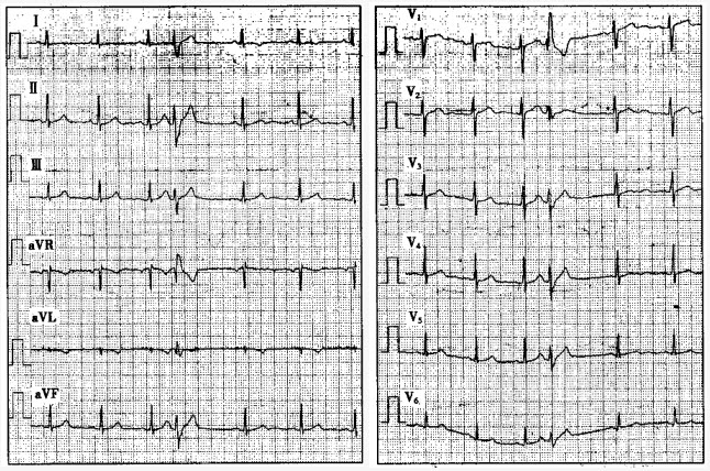 患者男性，23岁，体检。心电图如下图所示，应诊断为（）。