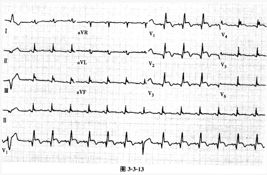 患者女性，76岁。因突发胸痛1天伴晕厥急诊，心电图如图3-3-13所示。心电图中第8个QRS波群变窄