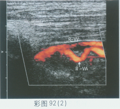 临床资料：女，74岁，主诉转颈后眩晕。超声综合描述：左侧椎动脉内径0．33cm，走行正常，右侧椎动脉