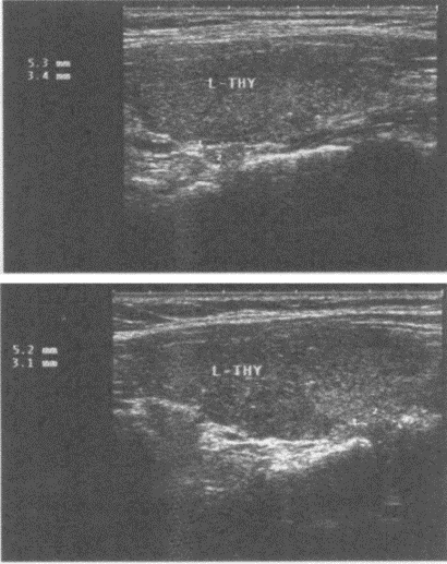 临床资料：男，49岁，常规体检。超声综合描述：甲状腺左叶上、下极后方可见大小均为0．5cm×0．3c