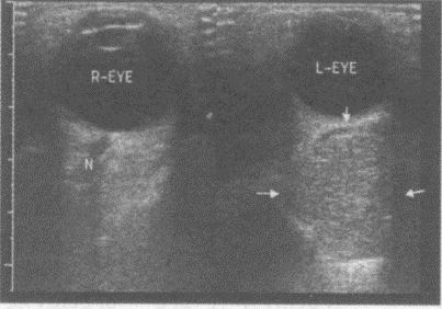 临床资料：男，49岁，自述左眼胀不适6个月，进行性眼球向外突出，视力下降。超声综合描述：左眼球后可见
