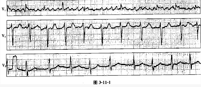 患者女性，45岁，风湿性心脏病。心电图如图3-11-1所示，应诊断为（）。