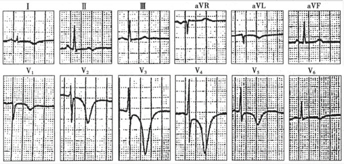 患者男性，55岁，反复发作心前区疼痛2年，2周前查心电图示左室面导联ST段压低0．05mV，T波低平