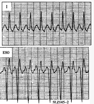 患者女性，36岁，因反复发作心慌行食管电生理检查，心动过速时的心电图如下图（图中ESO为食管心电图）