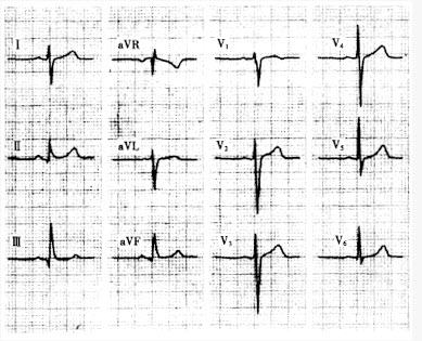 患者男性，45岁。因骨折住院，心电图如图所示，应考虑为（）。