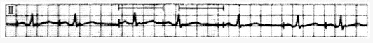 AAI起搏器患者发现长、短两种不同的起搏间期，如图所示，引起该现象最可能的原因是（）。