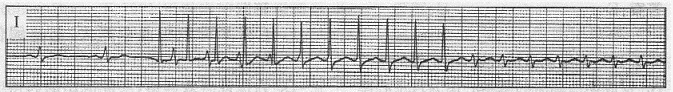 患者女性，24岁，因反复发作心慌行食管电生理检查。在下图中诱发出心动过速的刺激方法是（）。