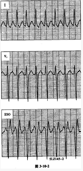 患者女性，36岁，因反复发作心慌行食管电生理检查，心动过速时的心电图如图3-10-2（图中ESO为食