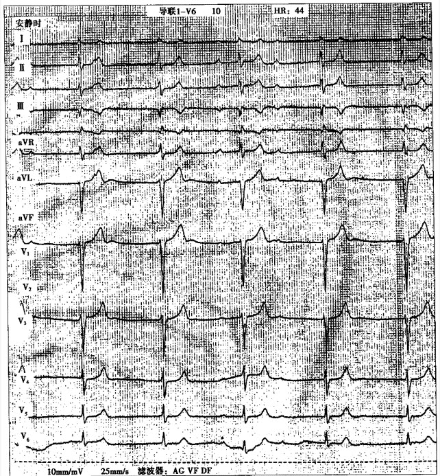 患者男性，64岁，头晕、胸闷2天。心电图如下图所示。有效不应期极度延长，大于逸搏间期（）。