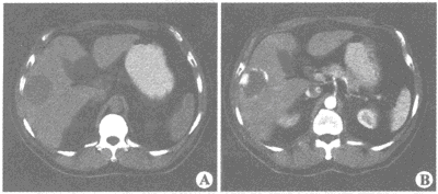 患者，女，40岁。体检时发现肝脏占位性病变．CT扫描如下图。应诊断为（）