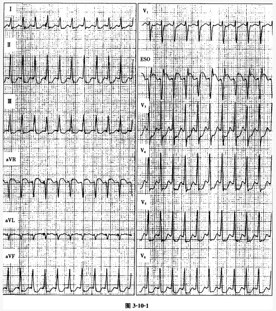 患者男性，23岁，因心动过速行食管电生理检查，心动过速时的心电图如图3-10-1（图中E．SO为食管