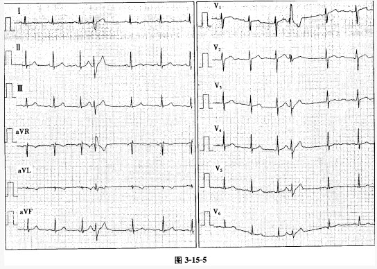 患者男性，23岁，体检。心电图如图3-15-5所示，应诊断为（）。