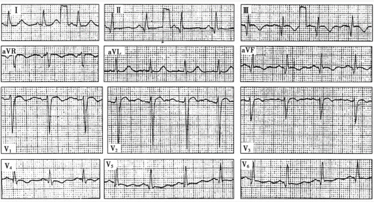 患者男性，56岁，1年前因急性心肌梗死入院，近3月胸闷，查心电图如下图所示，应诊断为（）。