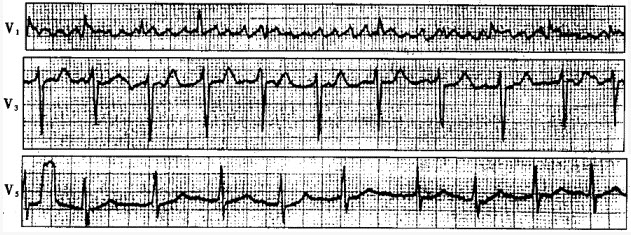 患者女性，45岁，风湿性心脏病。心电图如下图所示，应诊断为（）。