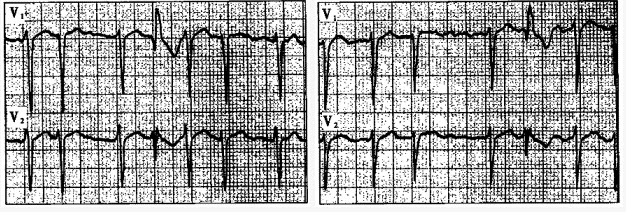 患者女性，57岁，高血压史10余年，心房颤动3年。心电图检查见下图，图中宽QRS波群应考虑为（）。