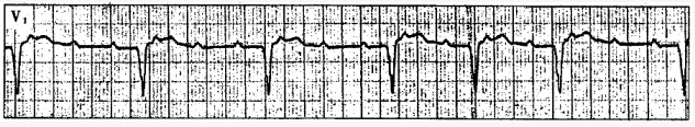 患者男性，47岁，胸闷。心电图如下图所示，应诊断为（）。
