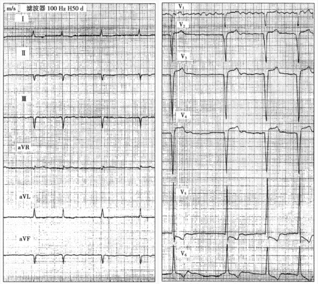 患者男性，40岁，扩张型心肌病。心电图如下图所示，与该心电图表现不符合的诊断是（）。