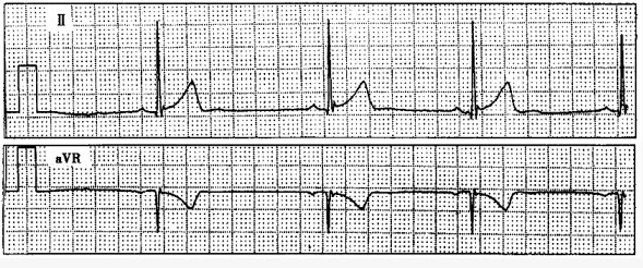 患者男性，62岁，心慌、胸闷待查。心电图如下图，应诊断为（）。
