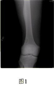 患者男，17岁，右大腿外侧间歇性疼痛逐渐加重近3个月，夜间为重，X线片及CT示右股骨干下段外侧骨皮质