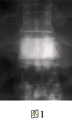 患者男，50岁。椎体正位X线平片及骨扫描检查见图1和图2。关于畸形性骨炎（Paget病）的诊断依据，