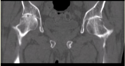 患者女，53岁，双髋关节痛。双髋关节CT平扫冠状重组影像如下图。对定性诊断有价值的征像包括（）