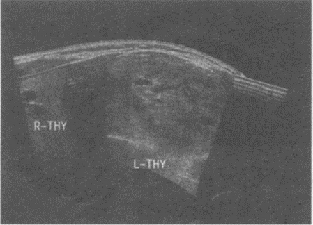 临床资料：女，45岁，自述发现左颈部包块1年余。超声综合描述：甲状腺右叶形态大小正常，内可见数个低回