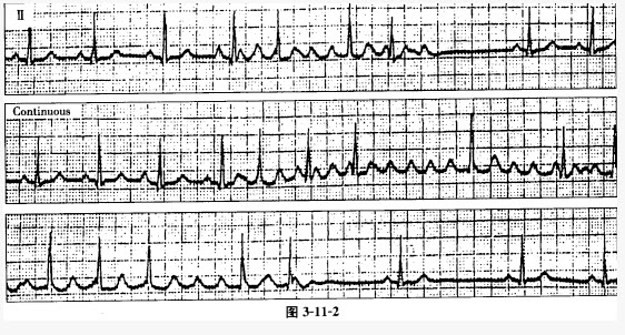 患者女性，45岁，甲状腺功能亢进，心电图如图3-11-2所示，应诊断为（）。