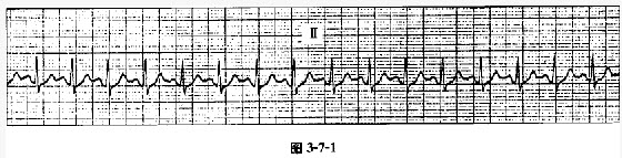 患者女性，31岁，心慌待查。心电图如图3-7-1所示，应诊断为（）。