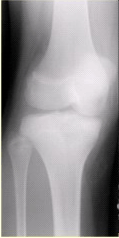 患者男，15岁。右膝X线平片和CT检查见下图。病变发生部位是（）