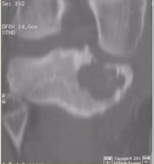 患者男，15岁。右膝X线平片和CT检查见下图。病变发生部位是（）