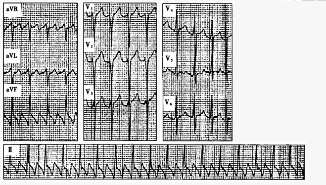 患者男性，22岁，突发心悸。心电图如下图所示，应诊断为（）。