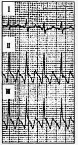 患者男性，22岁，突发心悸。心电图如下图所示，应诊断为（）。