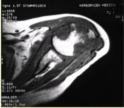 患者女，71岁，双侧肩痛半年余。有较长SLE病史和激素用药史。行左肩X线平片、MR检查（下图）。根据