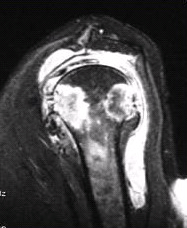 患者女，71岁，双侧肩痛半年余。有较长SLE病史和激素用药史。行左肩X线平片、MR检查（下图）。根据