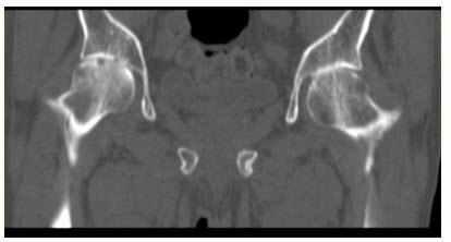 患者女，53岁，双髋关节痛。双髋关节CT平扫冠状重组影像如下图。可能的诊断为（）