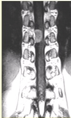 患者女，52岁，颈部不适2年。MRI检查结果如下图。关于脊膜瘤，正确的是（）